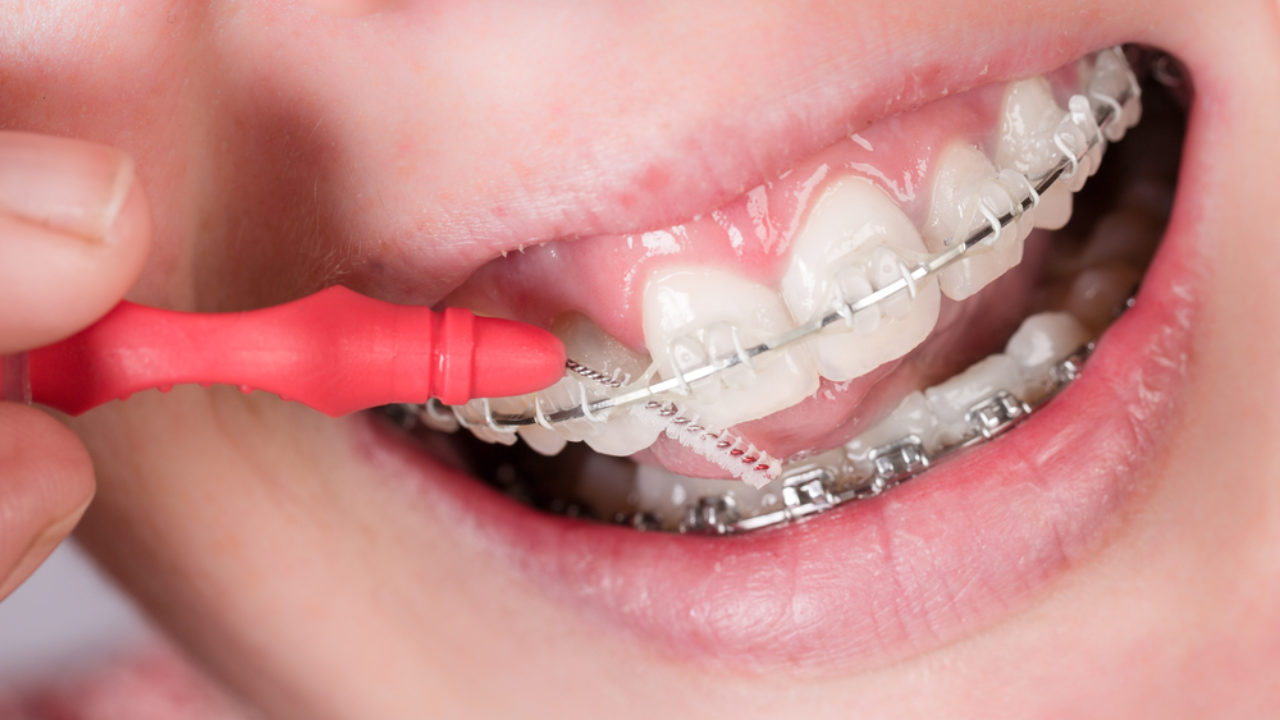 Dentist Braces Near Me: Which Is The Best Clinic For Orthodontics?