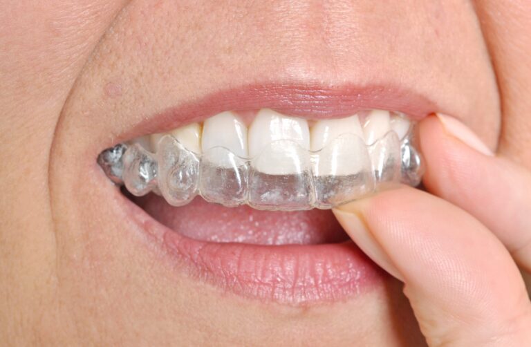 Invisalign Dentist Near Me: All Your Questions Answered