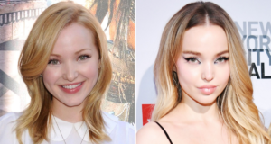 Dove Cameron – Before Plastic Surgery Dove Cameron - Before Plastic Surgery