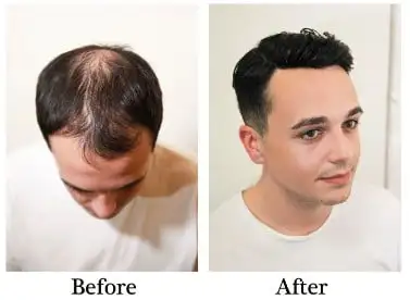 <strong>lWhat you should know about before getting hair systems for men</strong>