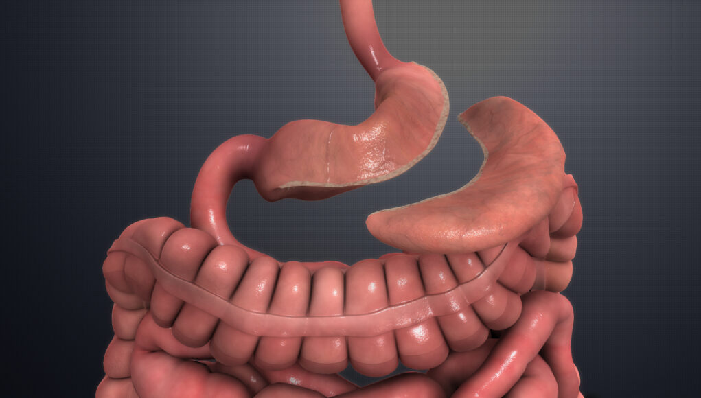 How Gastric Sleeve Lowers Type 2 Diabetes Risk Gastric Sleeve
