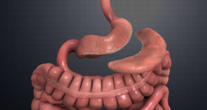 The Connection Between Gastric Sleeve and Reduced Risk of Diabetes Gastric Sleeve